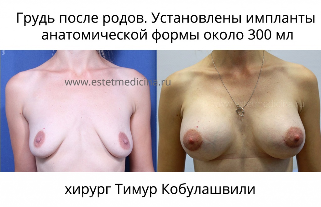 Хирург Тимур Кобулашвили. Восстановление формы груди после родов