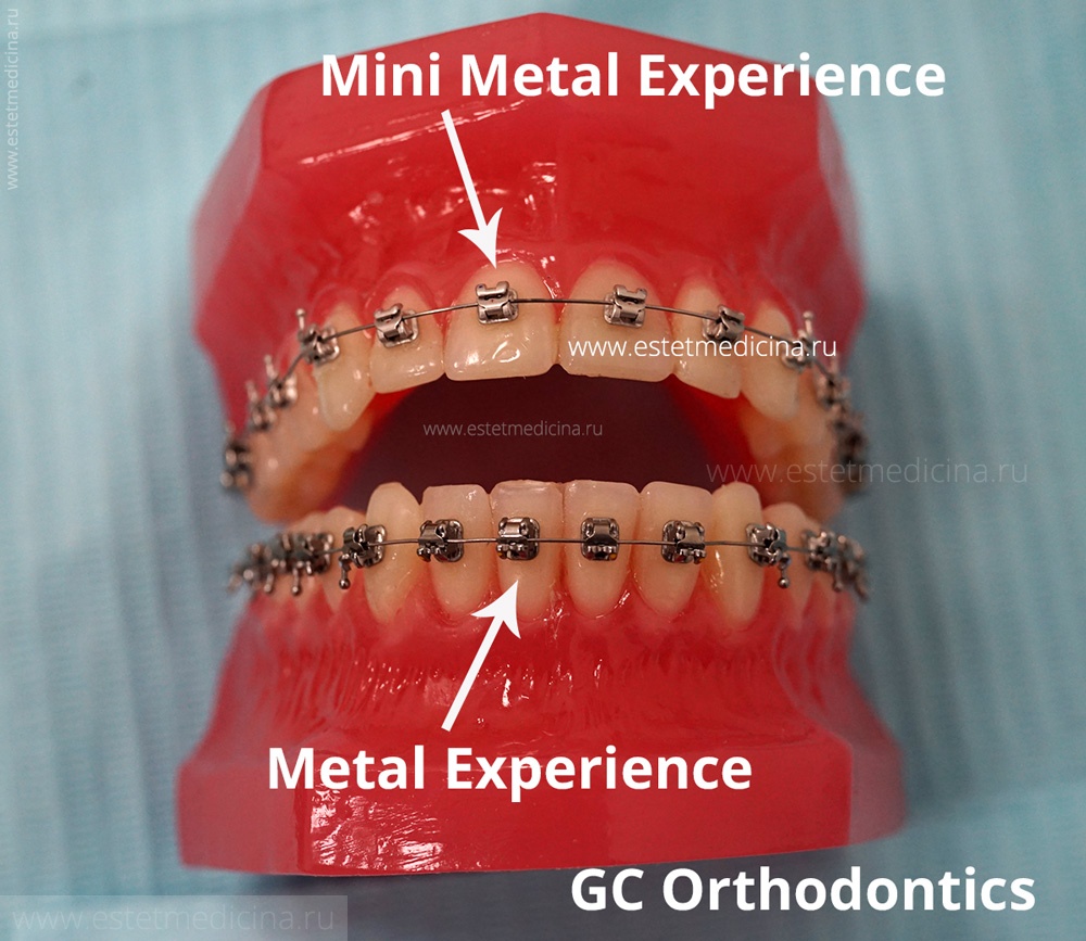 Experience система. Experience Mini Metal GC Orthodontic. Experience брекеты металлические.