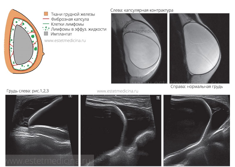 Имплант молочной железы. Капсулярная контрактура маммопластика. Капсулярная контрактура молочных желез УЗИ. Контрактура капсулы импланта молочной железы. Контрактура импланта молочной железы УЗИ.