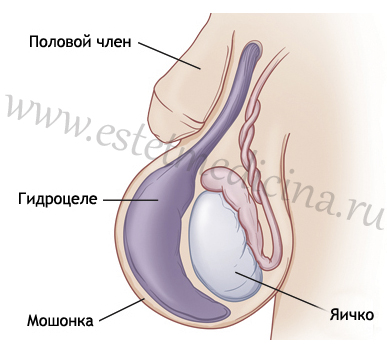 Гидроцеле (водянка яичек)