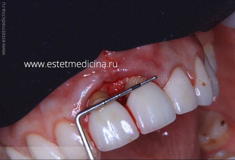 имплантация фронтальных зубов