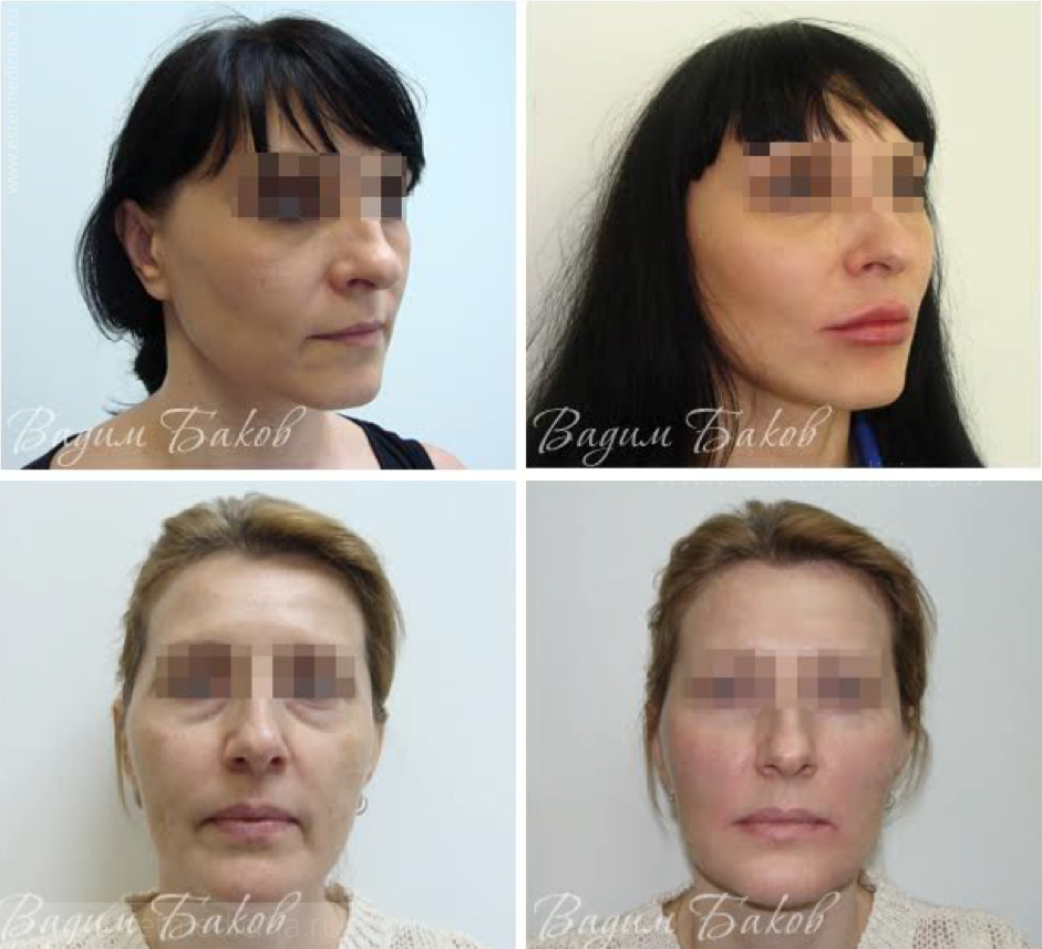 Фото «До» и «После» процедуры Софтлифтинг. Баков В.С.