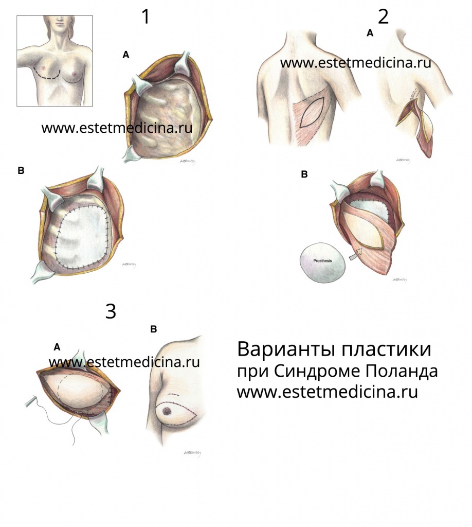 Синдром Поланда: фото, причины, лечение, наследственность Poland syndrome |  Интернет-журнал Estetmedicina.ru