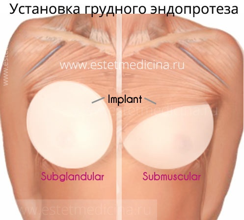 Имплант груди под железой и под мышцей 