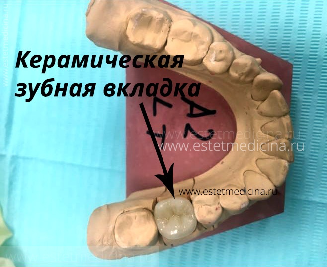 Керамическая зубная вкладка
