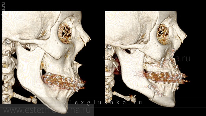 До и после лечения аномалии зубочелюстной системы