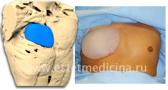 Импланты, замещающие грудную мышцу спины при Синдроме Поланда