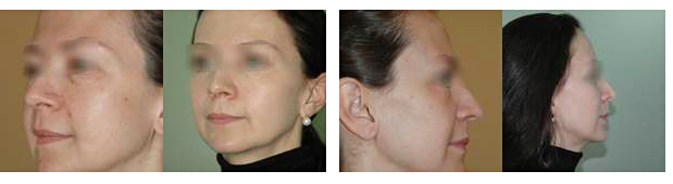 cheek-lift, чик лифтинг