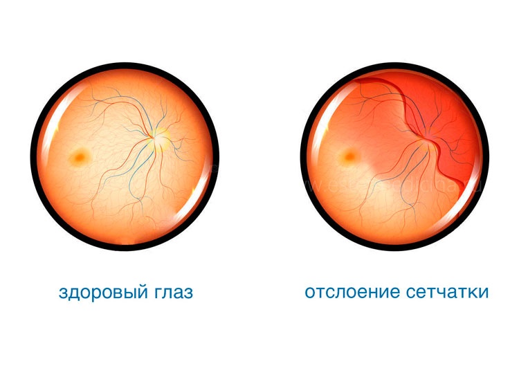 расслоение сетчатки глаза можно ли вылечить