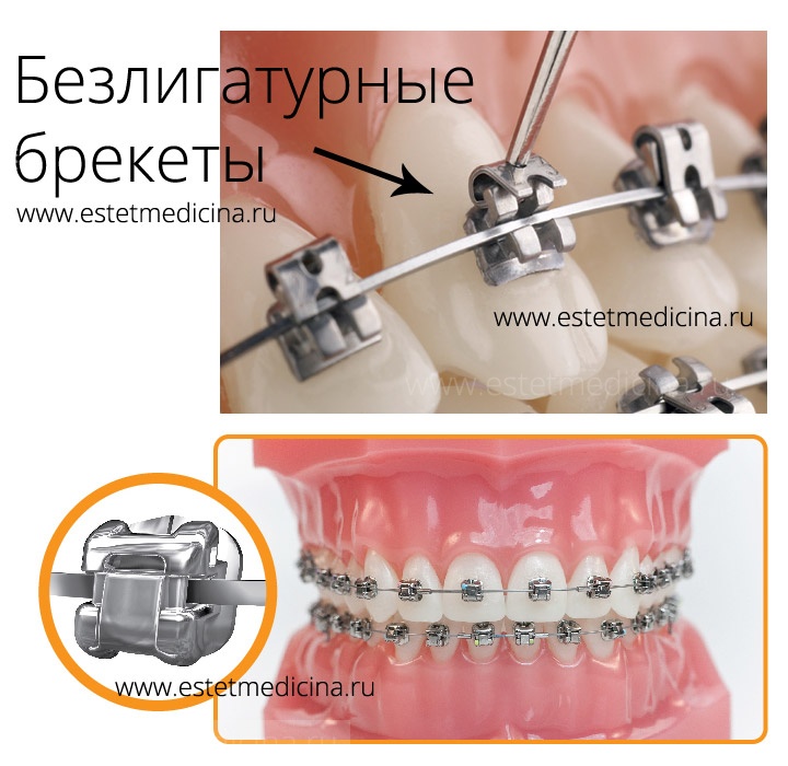 Лигатурные и самолигирующие брекеты фото