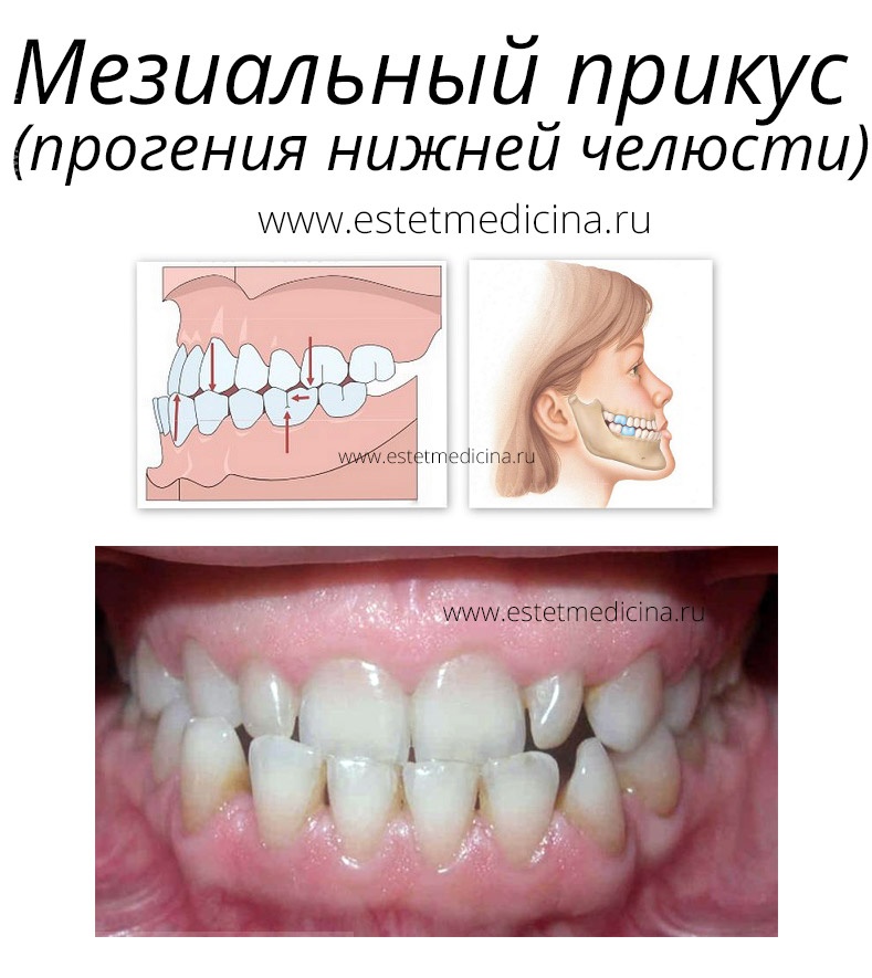 Фото прогения и прогнатия