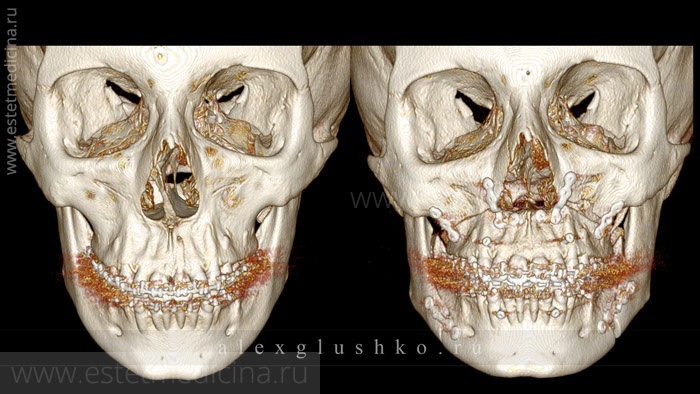 До и после ортогнастической операции. Челюсти закреплены в новом положении