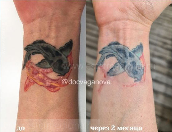 Удаление татуировок лазером в Москве