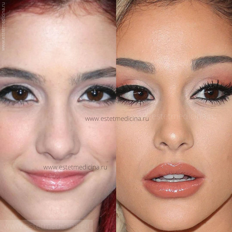 Ариана Гранде до и после пластики носа