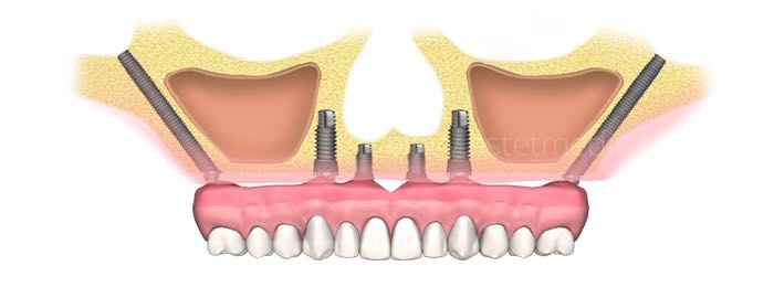 Скуловые импланты зубов