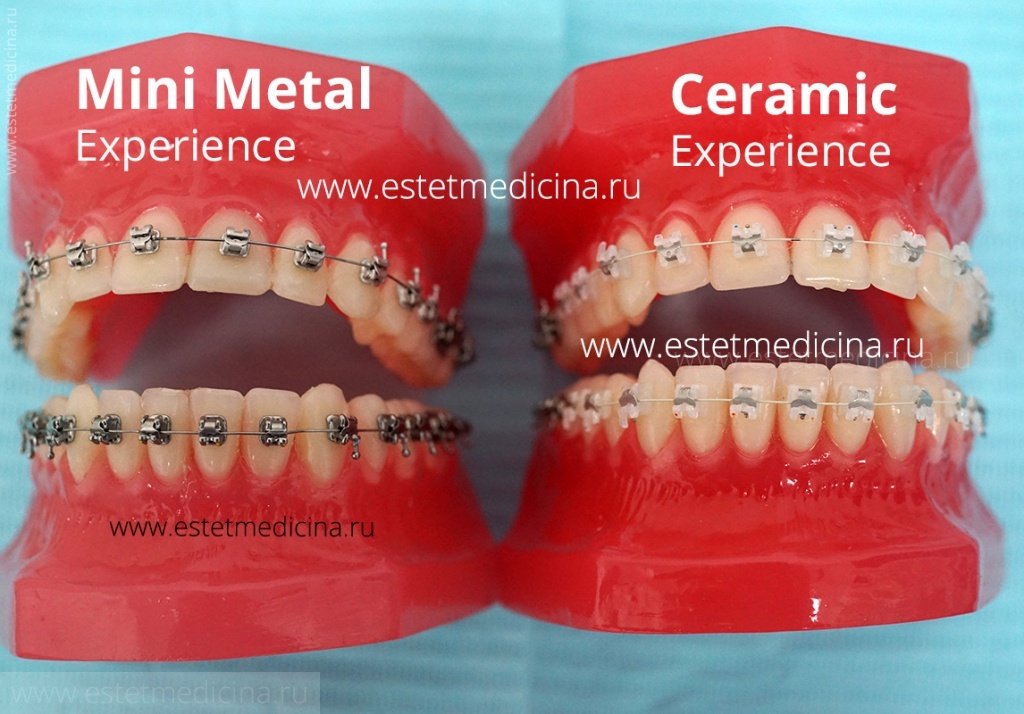 Experience система. Экспириенс металл брекеты. Experience Mini Metal GC Orthodontic.