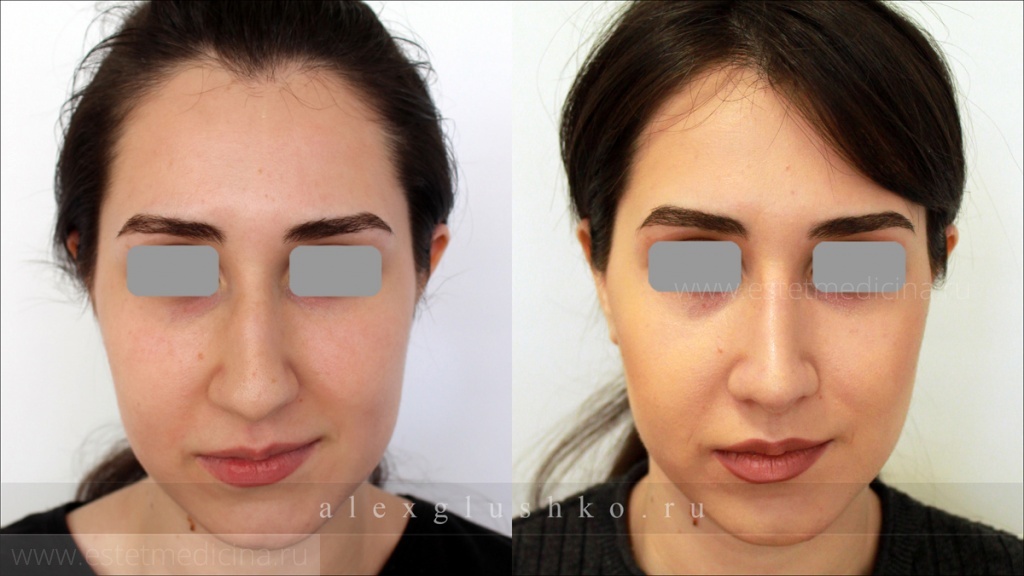 ринопластика хирург Александр Глушко