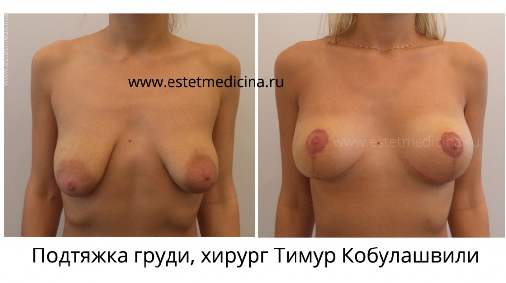 Подтяжка груди (мастопексия) хирург Тимур Кобулашвили