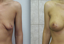 Салиджанов Анвар Шухратович, увеличение груди до и после 5