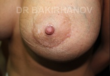 Бакирханов Сарвар Казимович, увеличение груди фото до и после -9