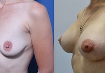 Фото до и после (1 месяц) увеличения груди. Хирург Тимур Кобулашвили