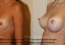 Погосян Давид Ашотович, увеличение груди до и после