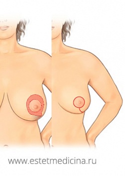 Методики подтяжки и уменьшения груди от Dennis Hammond и Ruth Graf