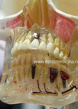 Имплантация зубов. Эксперт - Алакаева Тамара