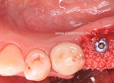 Одномоментное удаление зуба и установка дентального имплантата
