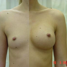 Якимец Валерий Григорьевич, увеличение груди до и после