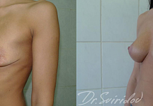 Свиридов Сергей Владимирович, увеличение груди до и после 4