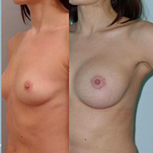 Свиридов Сергей Владимирович, увеличение груди до и после