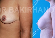 Бакирханов Сарвар Казимович, увеличение груди фото до и после -4