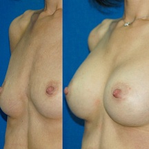 Егорова Мария Владимировна, увеличение груди фото до и после