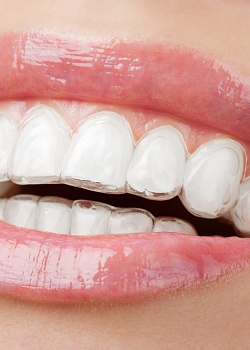 Ортодонтические прозрачные каппы