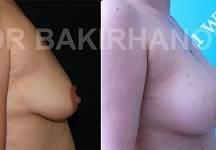 Бакирханов Сарвар Казимович, увеличение груди фото до и после -3