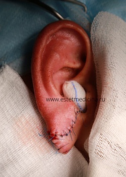 Пластика мочки уха: келоиды, тоннели. Клинические случаи