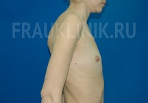 Егорова Мария Владимировна, увеличение груди фото до и после 3
