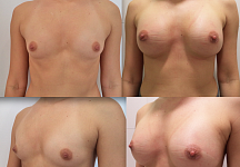 Фото до и после увеличения груди. Хирург Тимур Кобулашвили