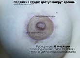 Рубец по ареоле соска после увеличения груди и подтяжки 6 месяцев