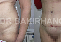 Бакирханов Сарвар Казимович, абдоминопластика фото до и после 2