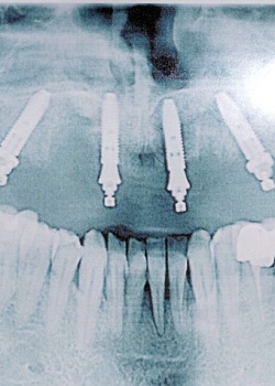 Имплантация зубов по системе «All-on-4», «All-on-6»
