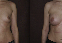 Салиджанов Анвар Шухратович, увеличение груди до и после 3