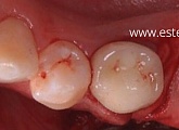 Одномоментное удаление зуба и установка дентального имплантата