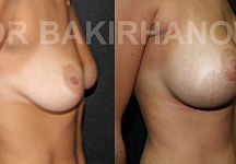 Бакирханов Сарвар Казимович, увеличение груди фото до и после -7
