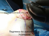 Ареолярная подтяжка на имплантах груди