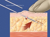 Липоаспирация подкожно-жировой прослойки