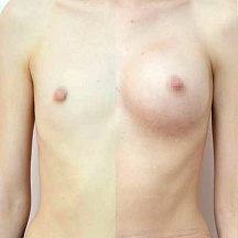 Маркушин Александр Александрович, увеличение груди фото до и после