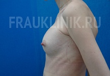 Егорова Мария Владимировна, увеличение груди фото до и после 4