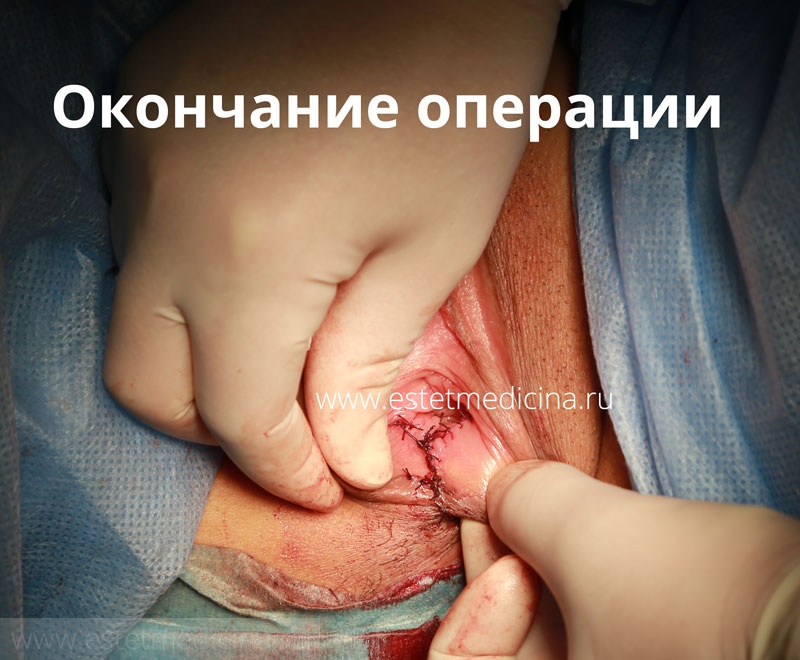 Отзывы после операции при опущении/выпадении матки - Хирург К. В. Пучков